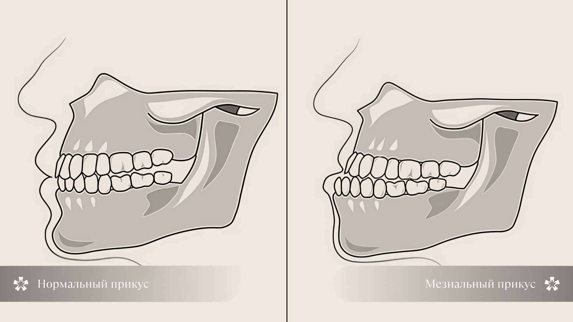 Мезиальный и нормальный прикус