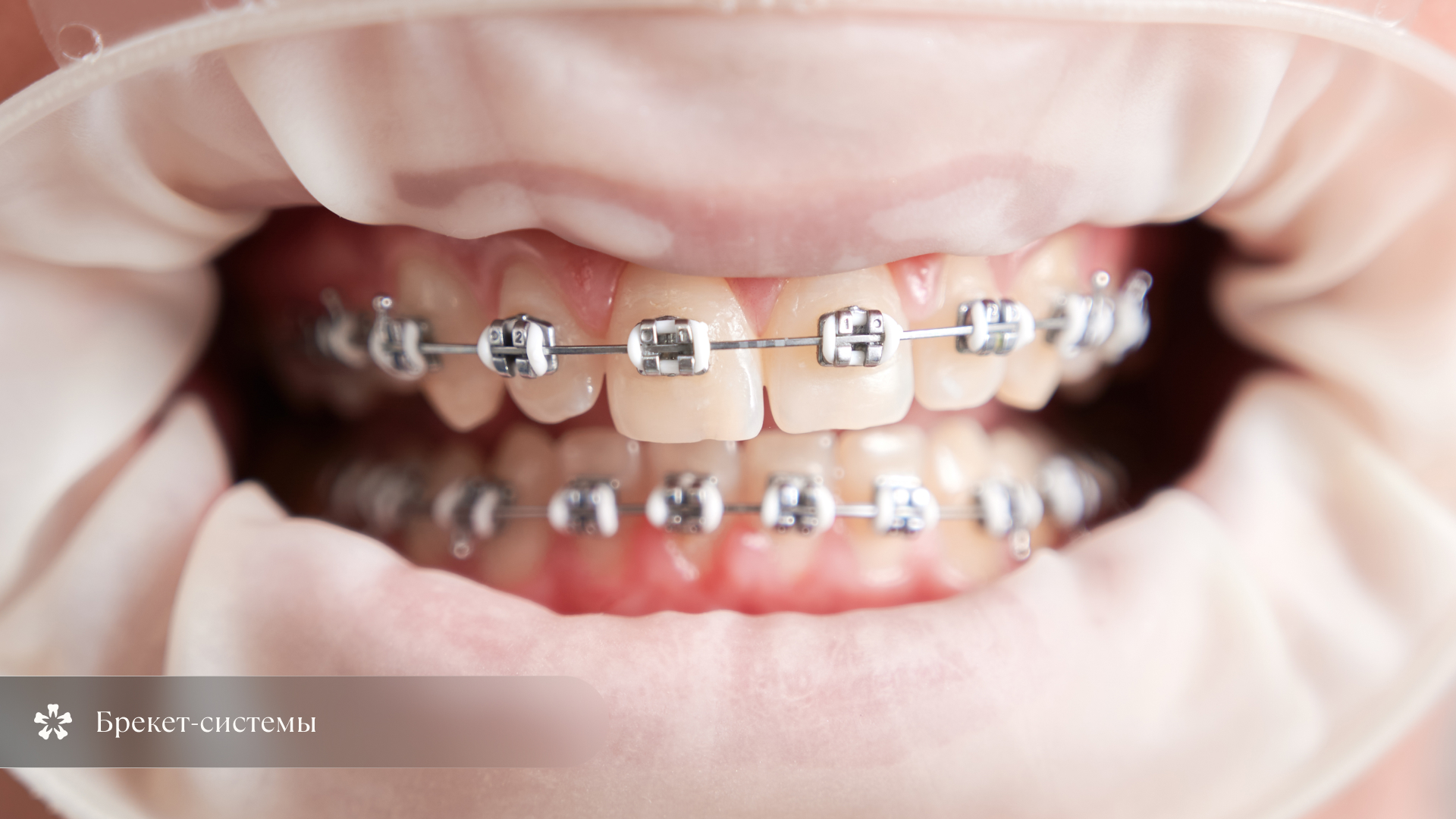 Брекеты для исправления открытого прикуса у детей и взрослых