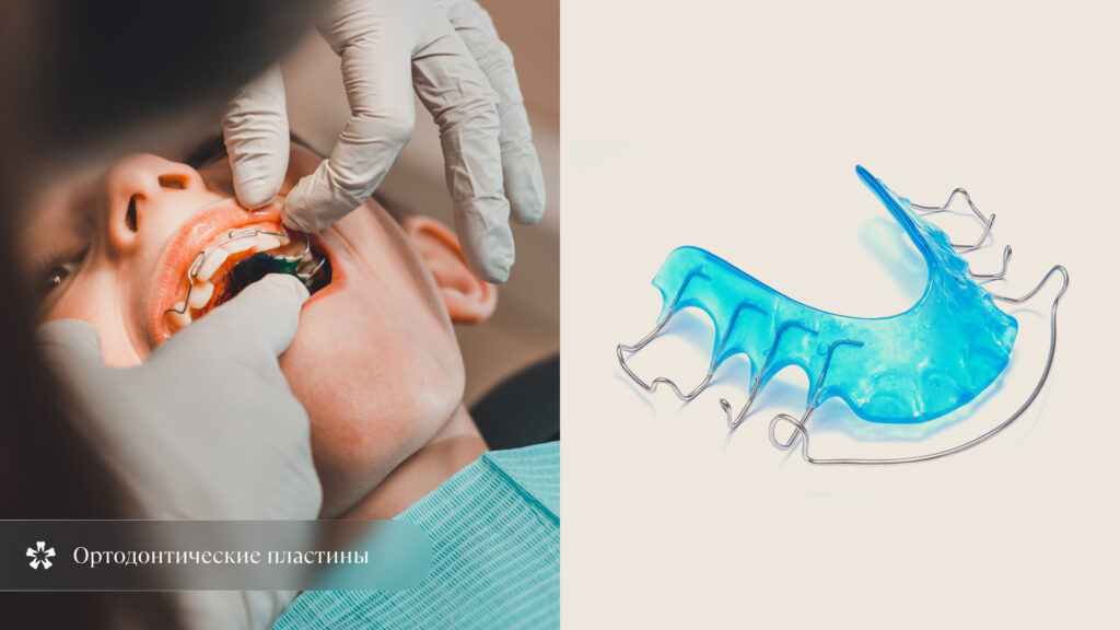 ортодонтическая пластина с заслонкой для языка для исправления открытого прикуса