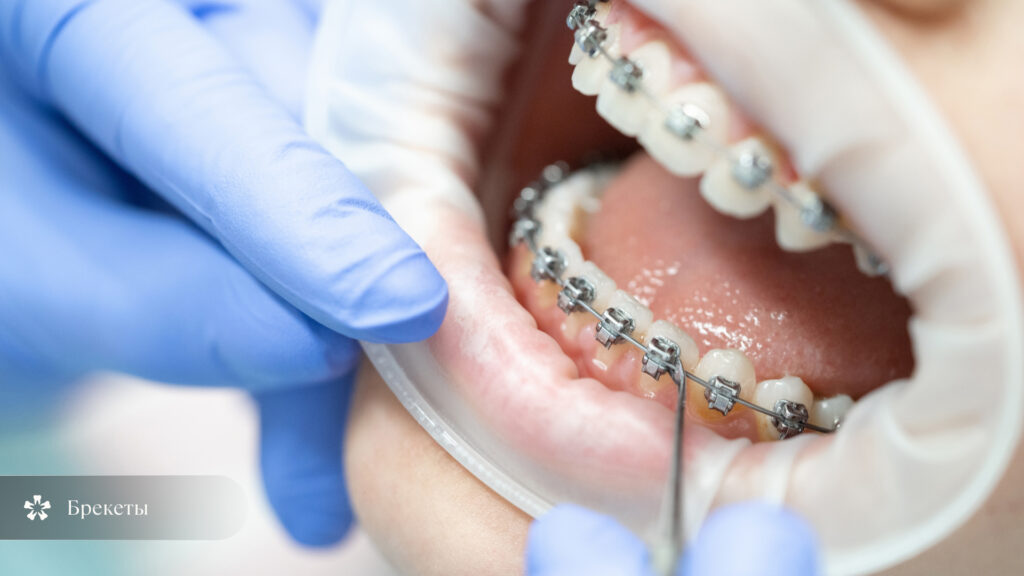 Иллюстрация установки брекетов для ортодонтического выравнивания зубов у пациента