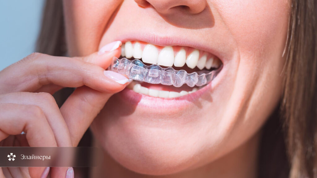 Иллюстрация использования прозрачных элайнеров для выравнивания зубов