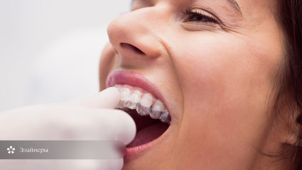 Установка прозрачного элайнера на зубы пациентки крупным планом